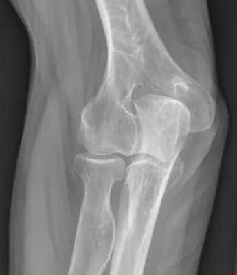 Radiograph from the case bank: Osteochondroma (exostosis)