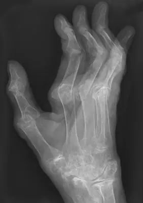 Radiograph from the case bank: Rheumatoid arthritis