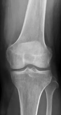 Radiograph from the case bank: Normal knee radiograph