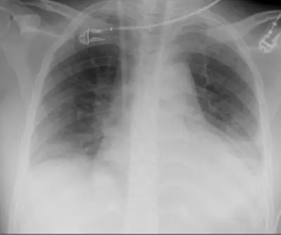 Radiograph from the case bank: Dialysis catheter