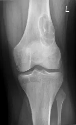 Radiograph from the case bank: Non-ossifying fibroma