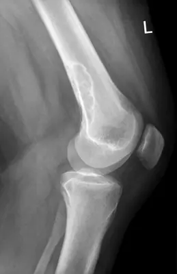 Radiograph from the case bank: Non-ossifying fibroma