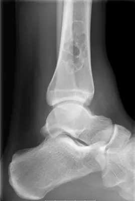 Radiograph from the case bank: Non-ossifying fibroma