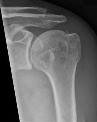 Radiograph from the case bank: Proximal humerus fracture