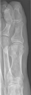 Radiograph from the case bank: Gout