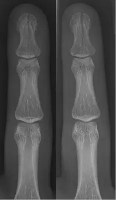 Radiograph from the case bank: Finger (phalangeal) fracture