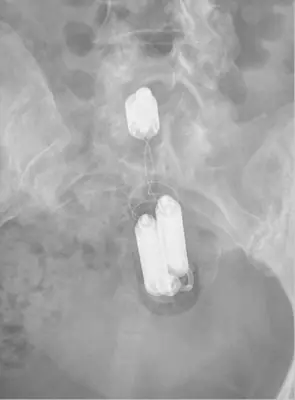 Radiograph from the case bank: Foreign body (ingested or inserted)