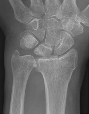 Radiograph from the case bank: Distal radius fracture