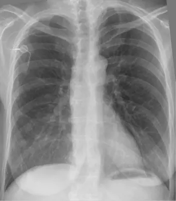 Radiograph from the case bank: Implanted venous access port (port-a-cath)